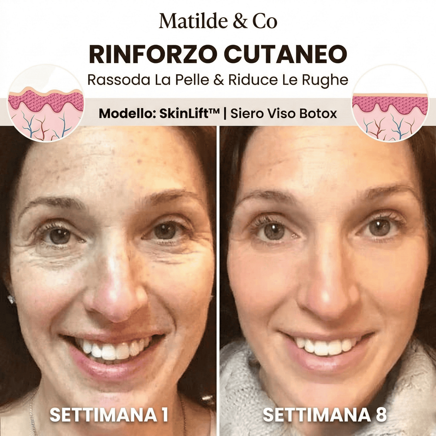 SkinLift™ | Siero Viso Botox